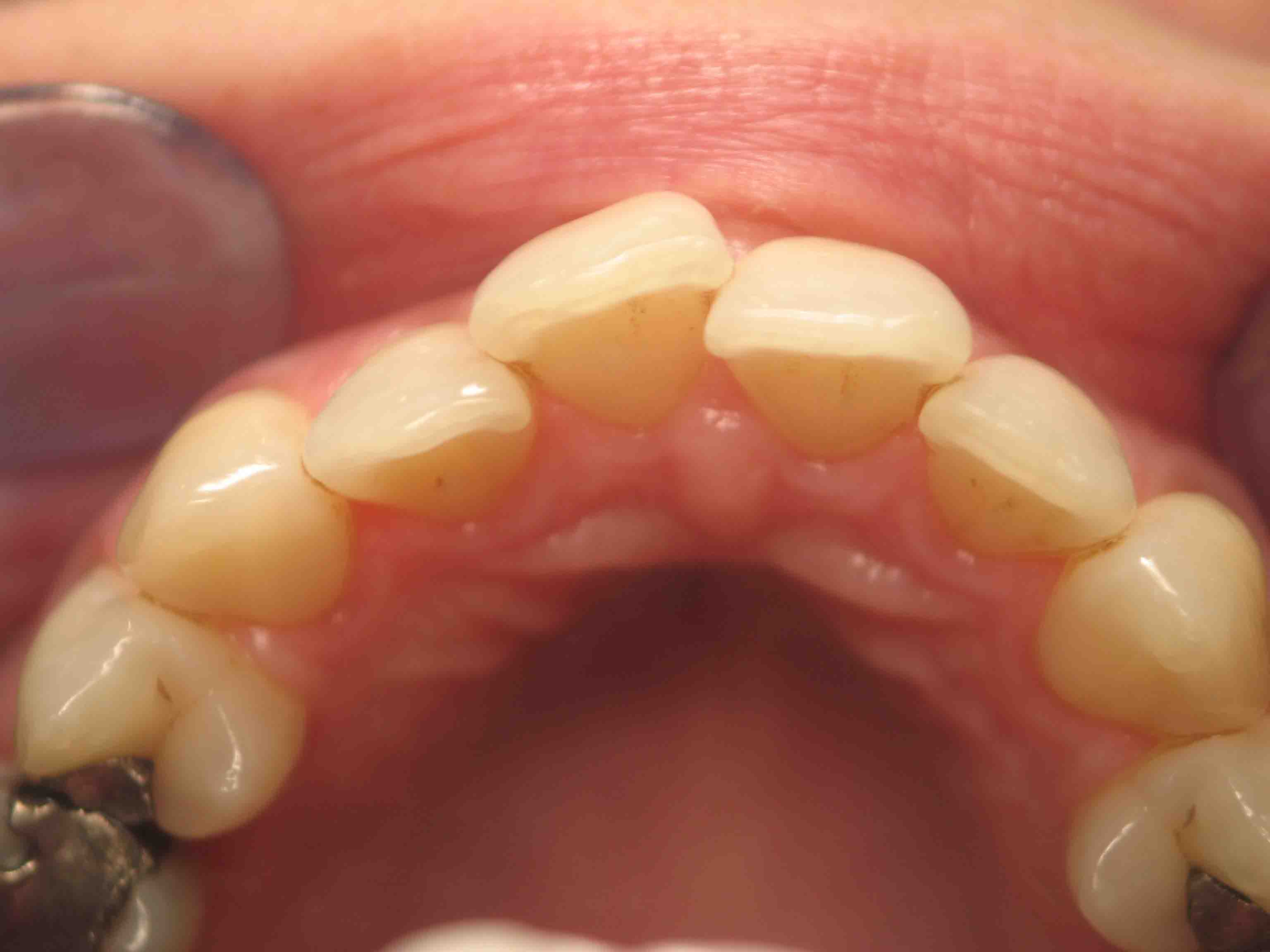 Before orthodontic treatment